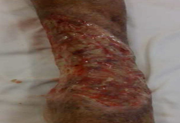 Antes